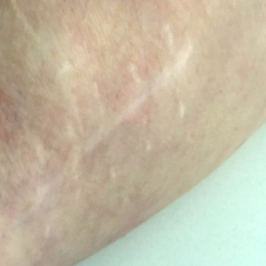 My Scars, My Story